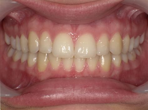 Wie lange vorher das hochzeitskleid. Invisalign® | Zahnschiene | Aligner - Ullrich ...