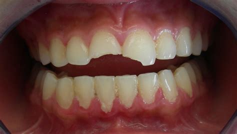 Reverses early gum damage · dentist recommended How Your Cosmetic Dentist Can Restore A Broken Or Chipped ...