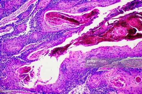 Micrograph Of Squamous Cells Carcinoma High Res Stock Photo Getty Images