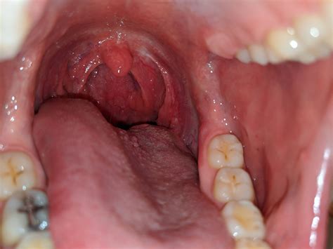 Left Sided Throat Pain 2 Weeks Left Submental Lymph Node Hpv