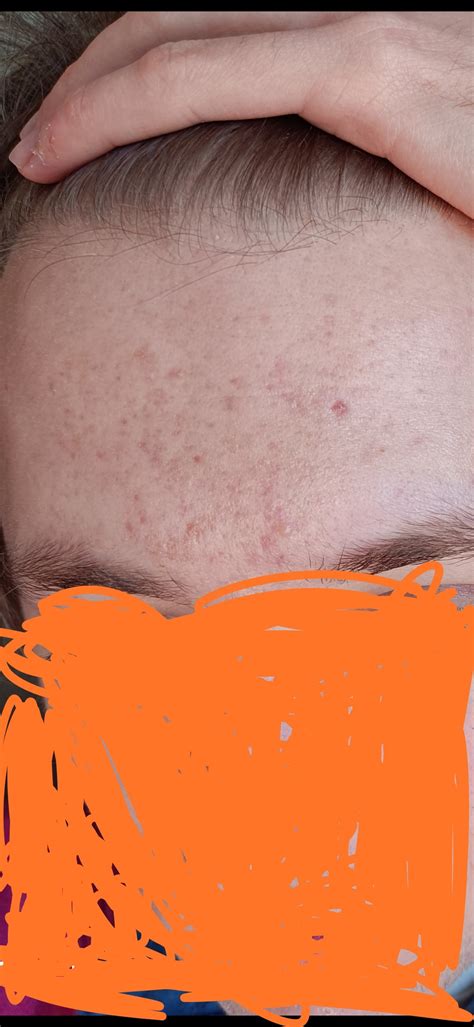 Skin Concerns Hi Does Anyone Have An Advice On How To Treat These