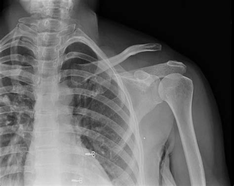 Acromioclavicular Joint Dislocations Acromioclavicular Joint