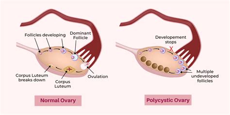 ovarian cysts polycystic ovaries and pcos explained