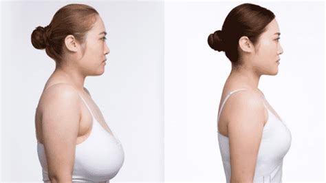 Does Medicare Cover Breast Reduction Grants For Medical