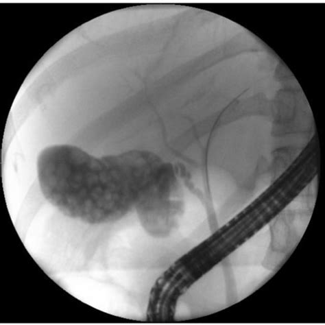 Endoscopic Retrograde Cholangiopancreatography Demonstrating One