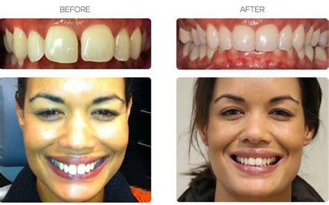 Invisalign And Braces For Gaps Before And After Results