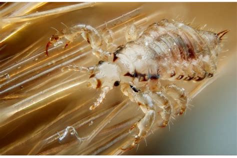 Super Strain Of Lice Causes Panic Williamson Source