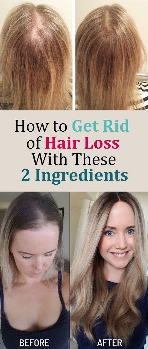 How To Get Rid Of Hair Loss With These 2 Ingredients Hair Loss Hair