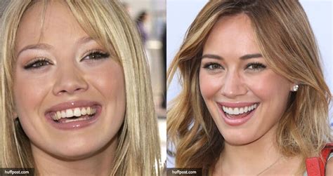 celebrities with dental implants smile team turkey