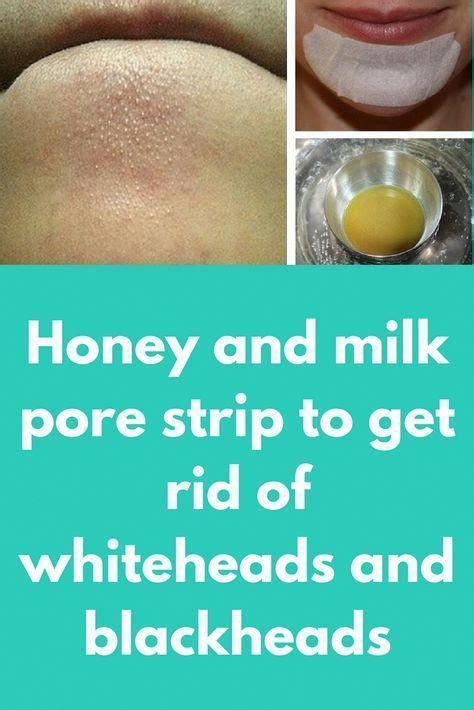 How To Get Rid Of Whiteheads Naturally At Home Beautypro Club
