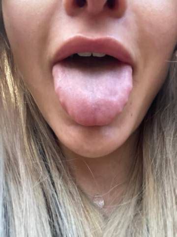 Currently, we are in phase 1a of pennsylvania's vaccine rollout. Zunge hat zahnabdruck? (Zähne)