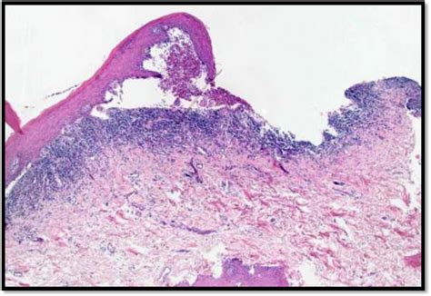 Oral Lichen Planus Histology