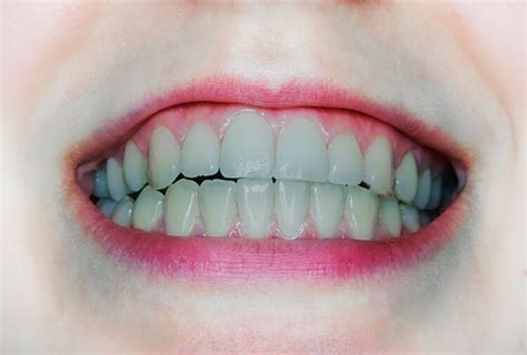 Gray Teeth Causes Treatment Self Care And Complications