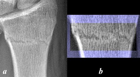 Structural Principles | Bone Fractures