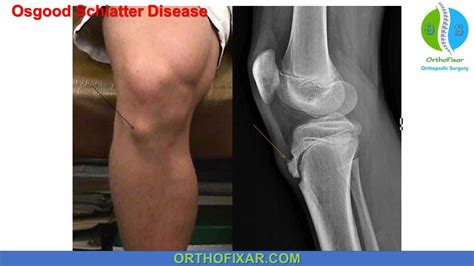 Osgood Schlatter Disease Full Detailed Orthofixar 2021