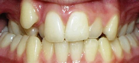 Posterior Crossbite