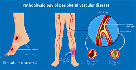 Peripheral Artery Disease Pathophysiology