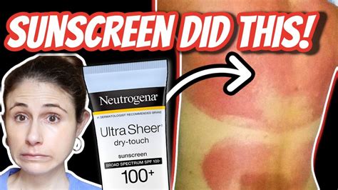 Sunscreen Allergic Reactions And Rashes Dr Dray Youtube