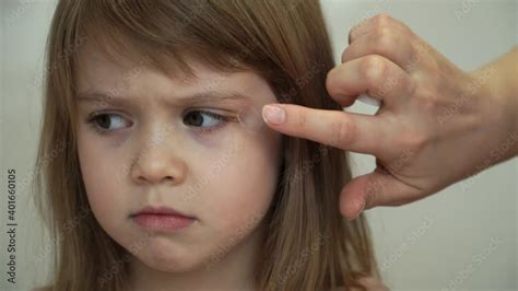 Mothers Hands Smear Bruise On Eye Of Little Girl Antiphlogistic