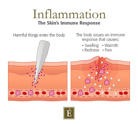 Kursus Bekam Online Apakah Itu Keradangan Inflammation