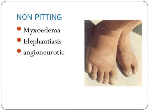 Causes Of Edema