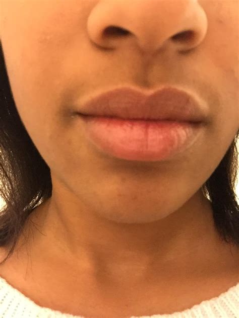 Skin Concerns How To Lighten Shadow Above Upper Lip Melasma