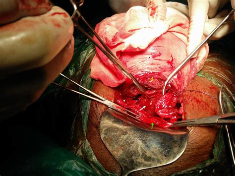 Prolapse uterus,cervix amputation,conservative mesh repair ,dr c v hegde,mumbai. Journal of Postgraduate Gynecology & Obstetrics: Inclusion ...