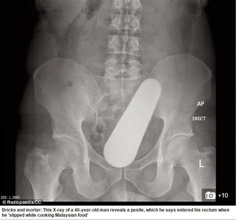 Chyna Durus Blog Doctors Share Xrays Of The Strangest Things Theyve Found Stuck In Peoples Rears