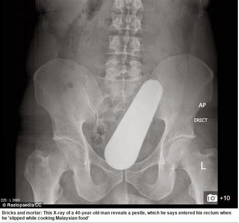 PHOTOS Xrays Of The Strangest Things Found Stuck In Patients Rectums Gistmania