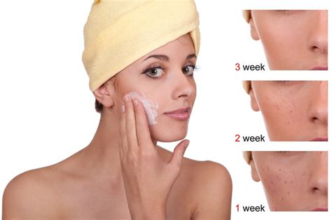 Sheabutter enthält das hautglättende vitamin e und allantonin, spendet der haut feuchtigkeit und hält sie elastisch, da sie die produktion von kollagen begünstigt. Acne Before and After Using Benzoyl Peroxide Persol Gel ...