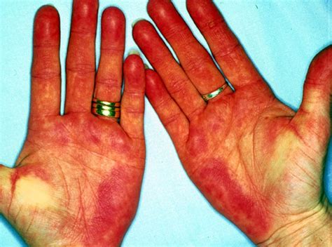 Palmar Erythema Pictures Definition Causes Treatment