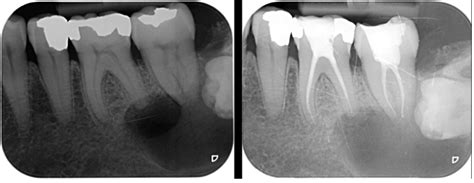 radicular cyst of jaw a case report