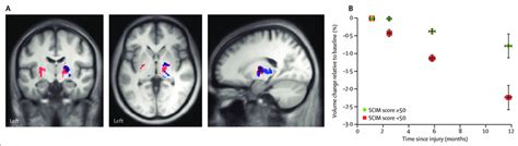 Correlation Between Brain Atrophy And Clinical Outcome A Overlay Of