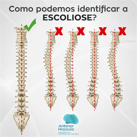 Escoliose Convexa A Direita
