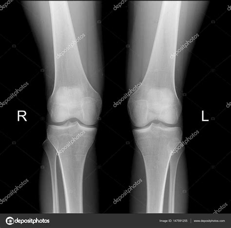 X Ray Of Healthy Knee Joint X Ray Of Knee Joints In Frontal