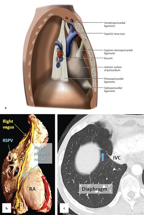 3 Mediastinum And Thymus Radiology Key