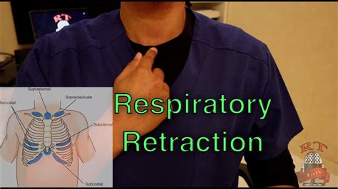 Recognizing Respiratory Distress Respiratory Retraction علامات صعوبة