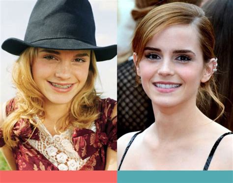 Celebrities With Braces Before And After Wonderful Transformations Jumbuck