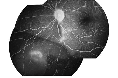 Fluorescein Angiogram Of The Left Eye Left Eye Fluorescein Angiogram