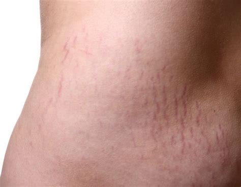 How To Get Rid Of Stretch Marks The Causes Best Products And How To
