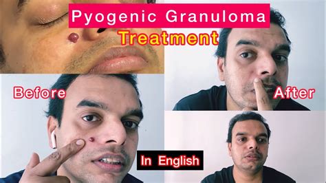 What Is Pyogenic Granuloma And Cheapest Treatment Surgery Best Mole