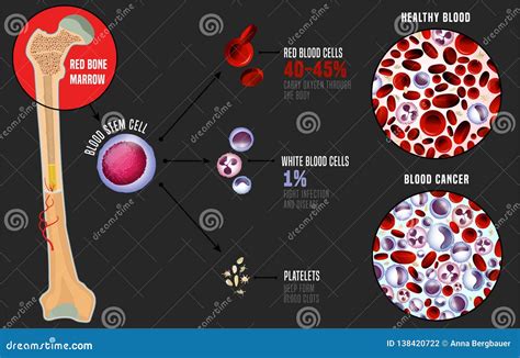 Leukemia Vs Normal Blood Royalty Free Stock Image