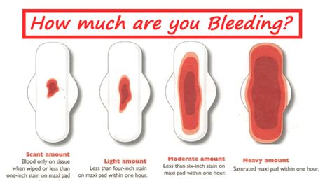 Are Blood Clots During Period Normal