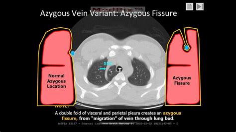 Chest Radiology The Azygous Fissure A Normal Variant Youtube