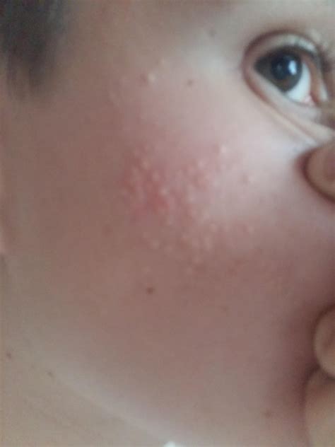 What Is This Acne From General Acne Discussion Forum