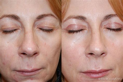 Eric M Joseph Md Eyelid Surgery Before After Photos