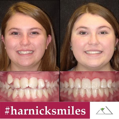 Harnick Orthodontics Albuquerque Braces And Invisalign Results