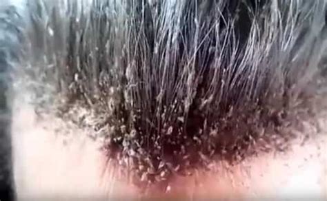 Many people also use vinegar to combine both remedies. Will Hair Dye Kill Lice? | IYTmed.com