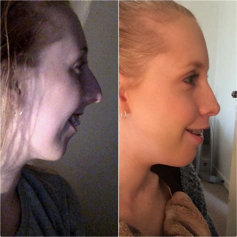 3 Weeks Post Double Jaw Surgery Journey