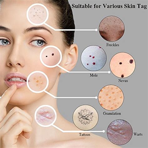 Removing Moles And Skin Tags North York Cosmetic Clinic